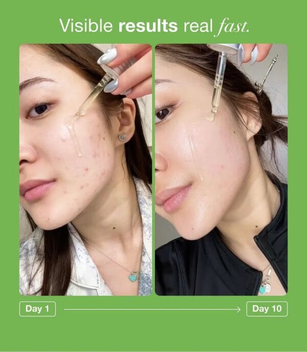 WhatsApp Image 2025-09-13 at 09.05.20_991bd9bb ANUA AZELAIC ACID 10 HYALURON REDNESS SOOTHING SERUM - 30ML | أنوا سيروم الآزليك اسيد المهدئ للبشرة - ٣٠ مل