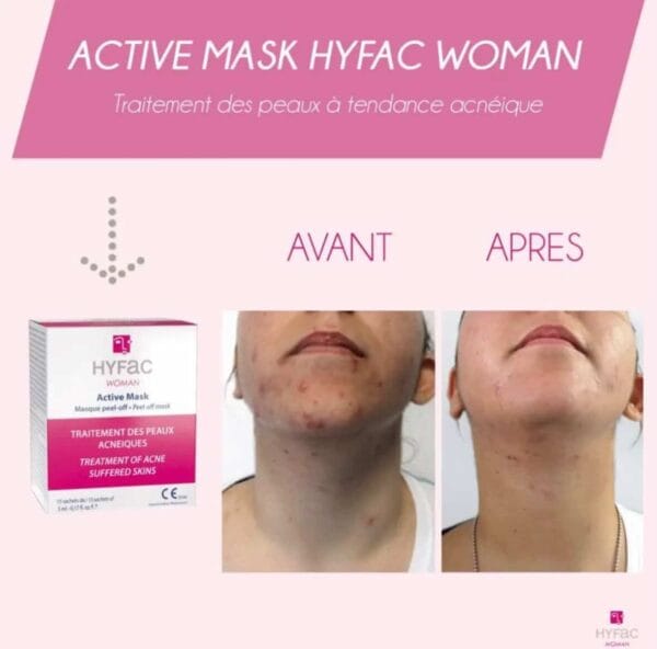 Hyfac Woman Active Mask Peel-Off Mask - 15 Sachets | هايفك ماسك لحبوب الوجه عند البالغين - 15 قطعة