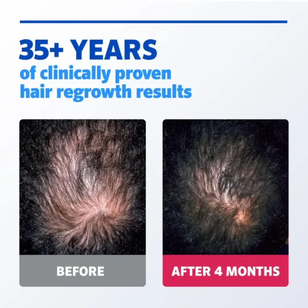 ROGAINE® 5% Minoxidil Solution - 3-Month Supply - 3x60ml | روكين محلول مينوكسديل 5% كورس علاجي لمدة 3 أشهر لإعادة نمو الشعر - 3x60 مل